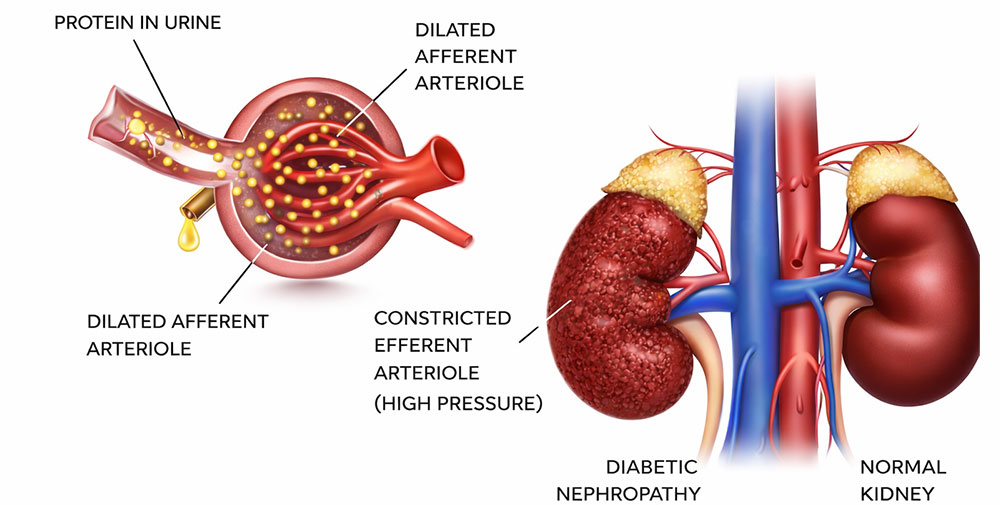 Diabetic & Hypertensive Kidney Disease