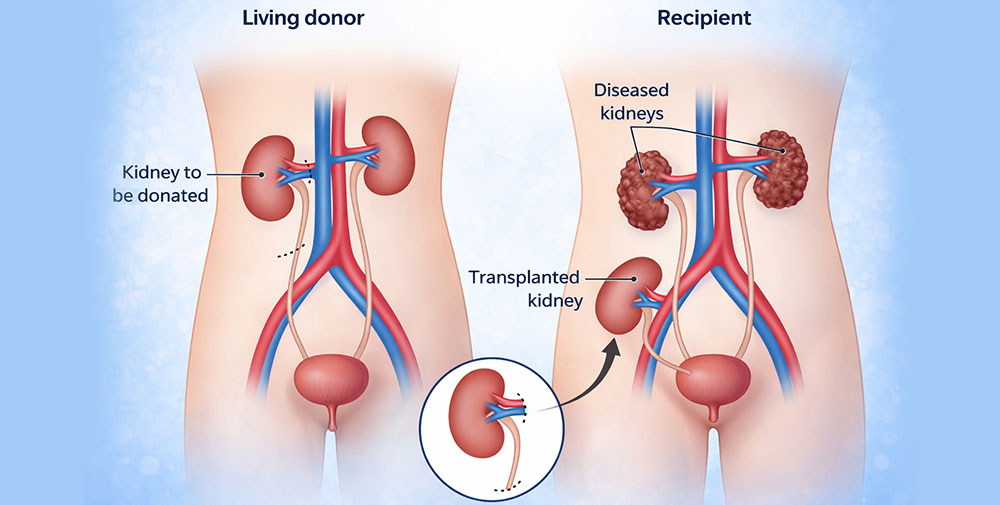 Dialysis & Renal Transplant