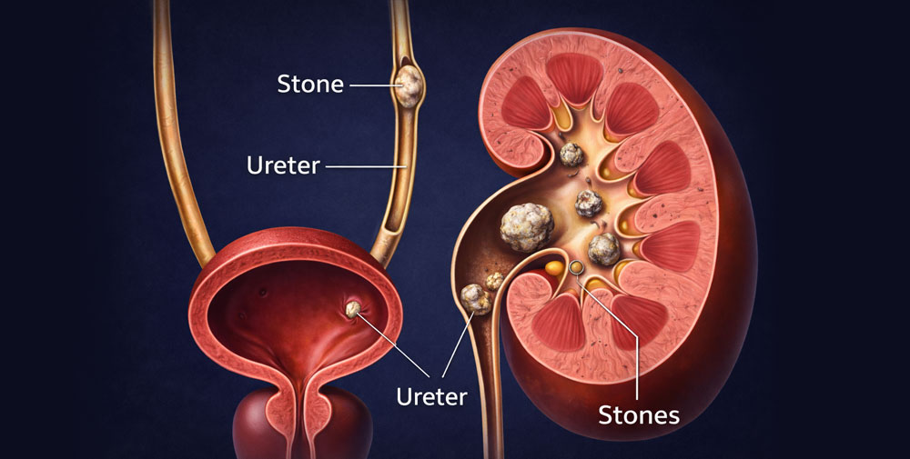 Medical Management of Kidney Stones